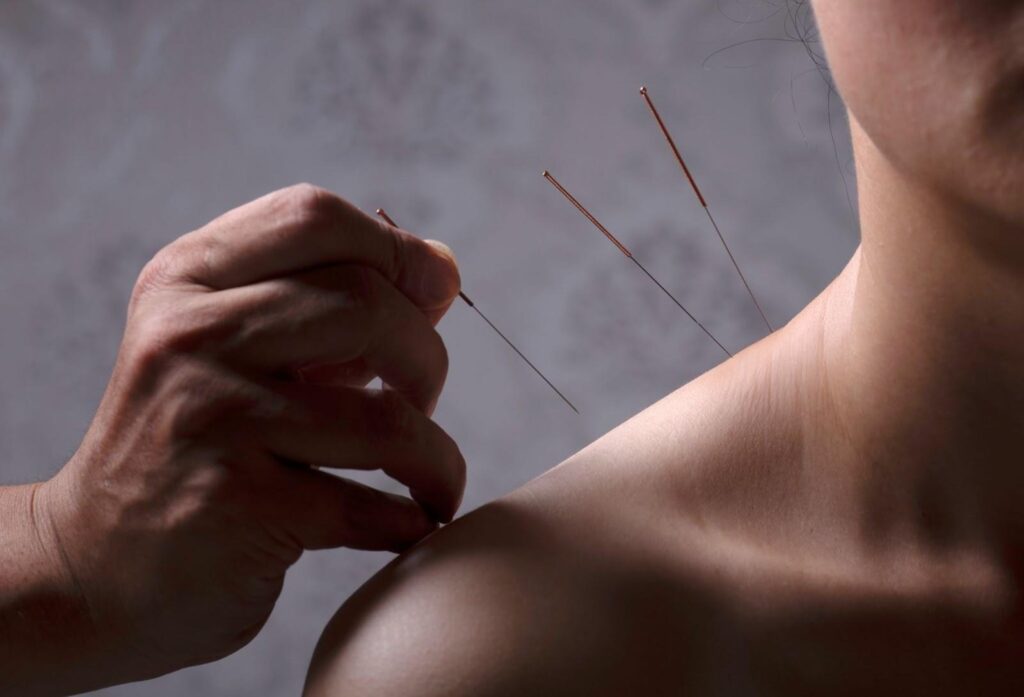 Acupuncture vs. Dry Needling: What’s the Difference?